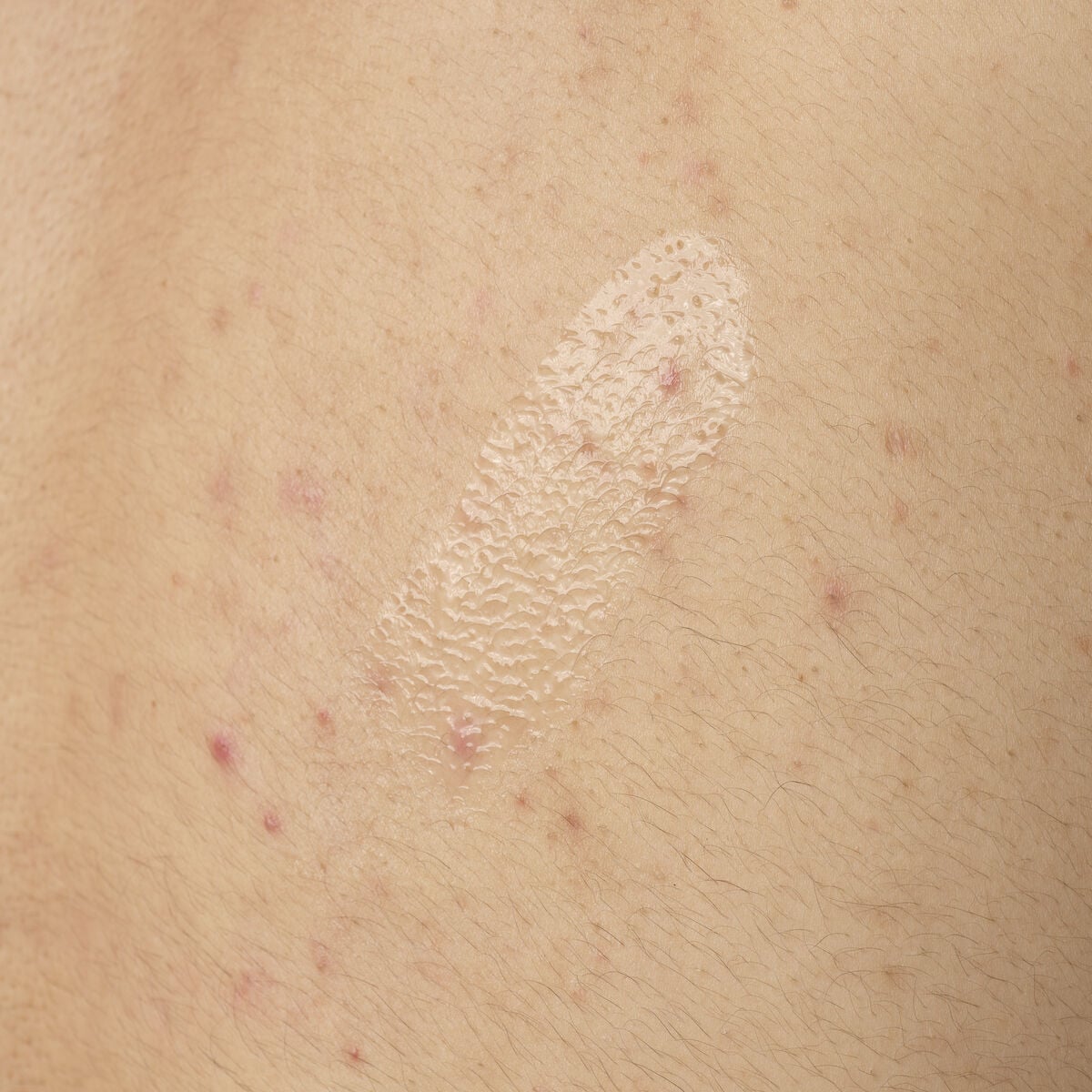 salicylic-acid-0-5-body-serum-y9 ORD-salicylic-acid-05-body-240ml-application.jpg