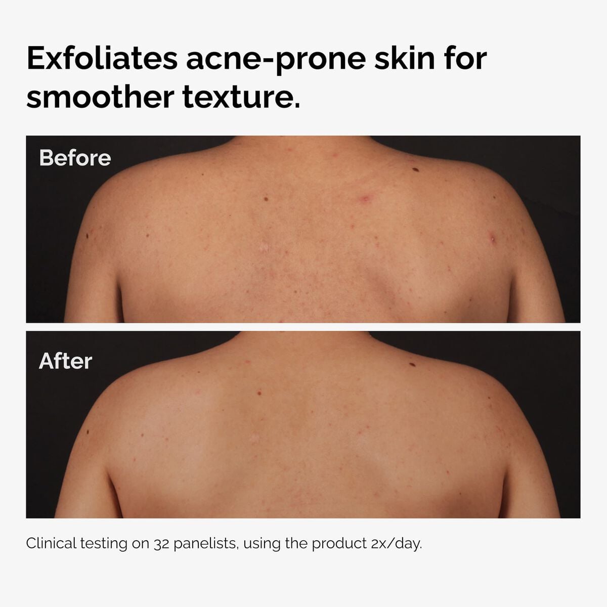 salicylic-acid-0-5-body-serum-o3 ord-salicylic-acid-body-serum-before-after-graphic-NA.jpg