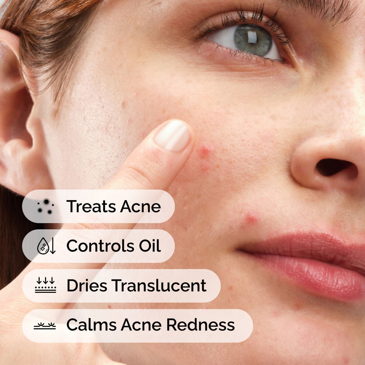 sulfur-10-powder-to-cream-concentrate-w4 ord-sulfur-10pct-powder-to-cream-concentrate-model-application-with-benefits-acne.jpg